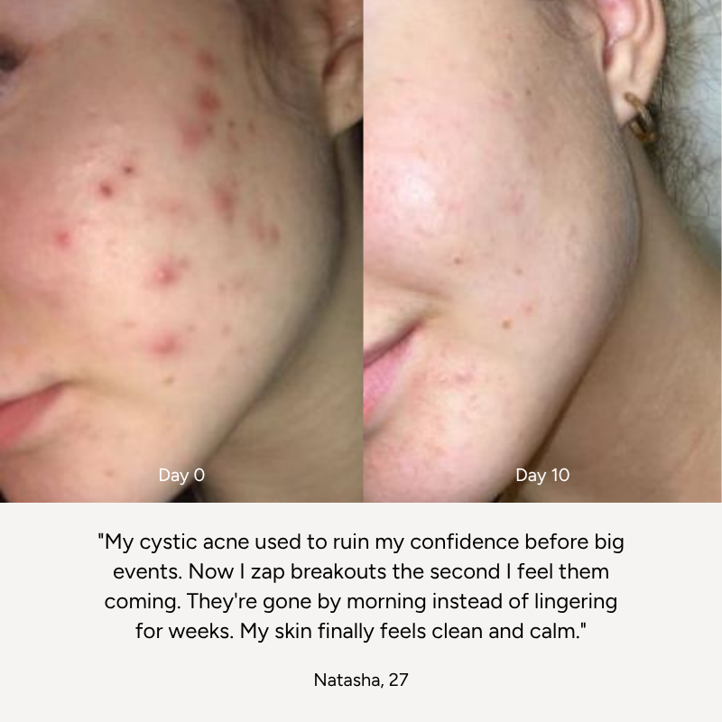 High-Frequency Wand™