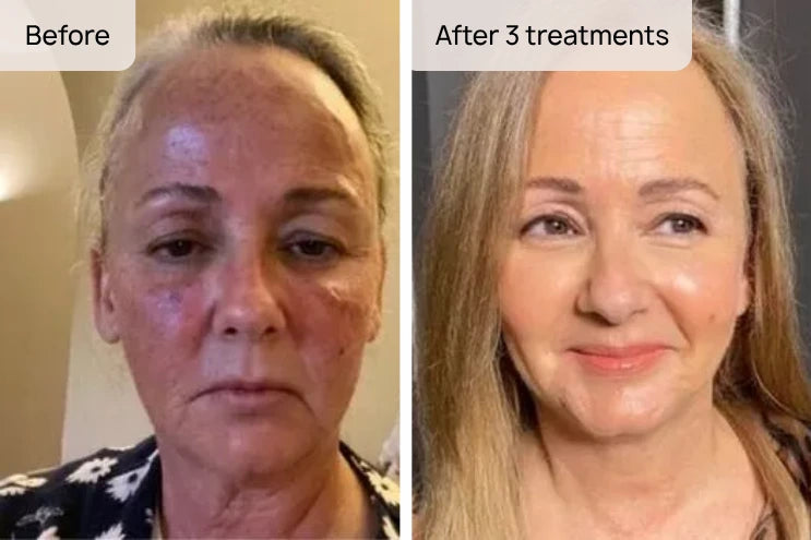 Restore Tone & Texture