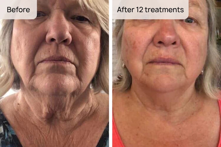 Firm & Lift Sagging Skin
