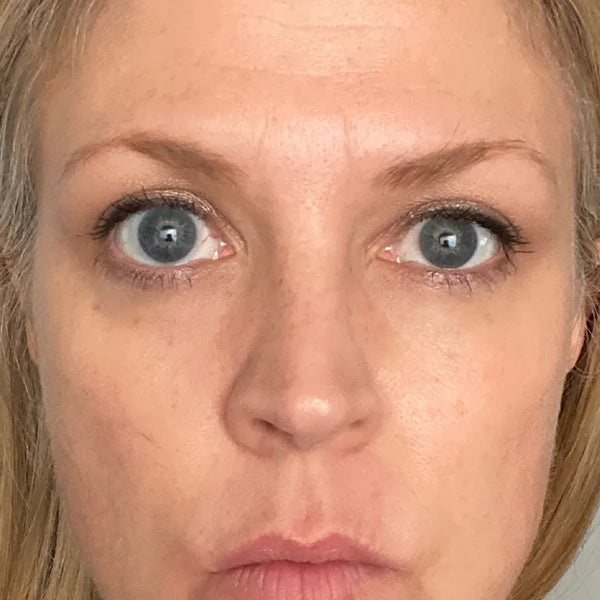Before treatment - Monique, 48