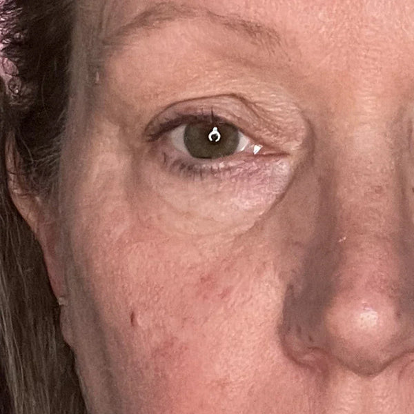 Before treatment - Sarah, 56