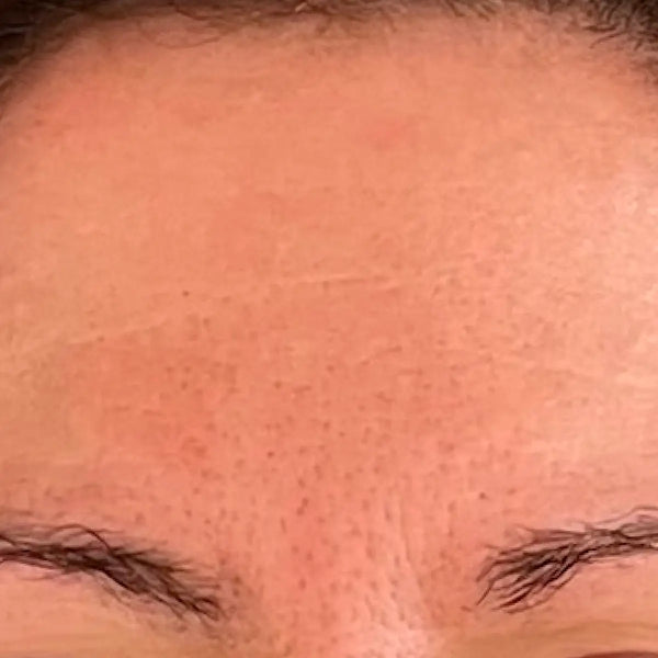 After treatment - Marie, 49