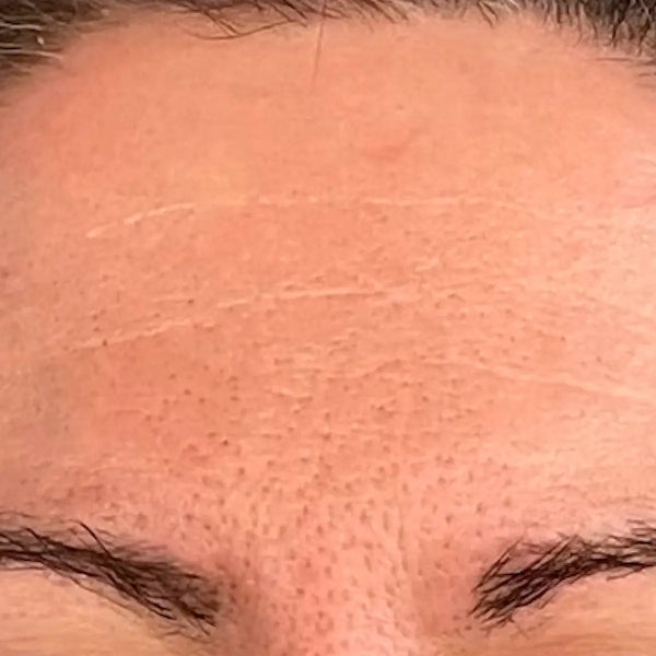 Before treatment - Marie, 49