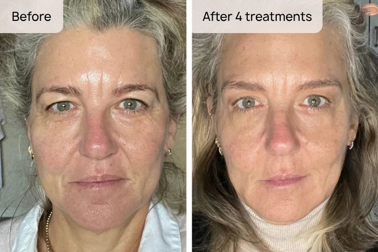 Customer before-and-after photo — after 4 treatments with the LUMN wand